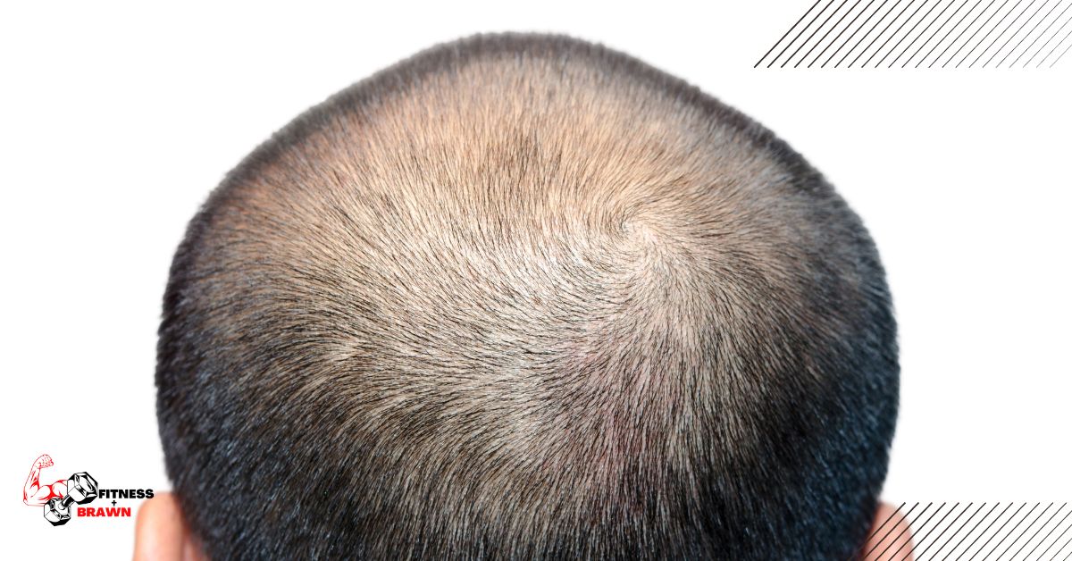 hairloss - Does Dianabol Cause Hair Loss? (Yes, Find Out)