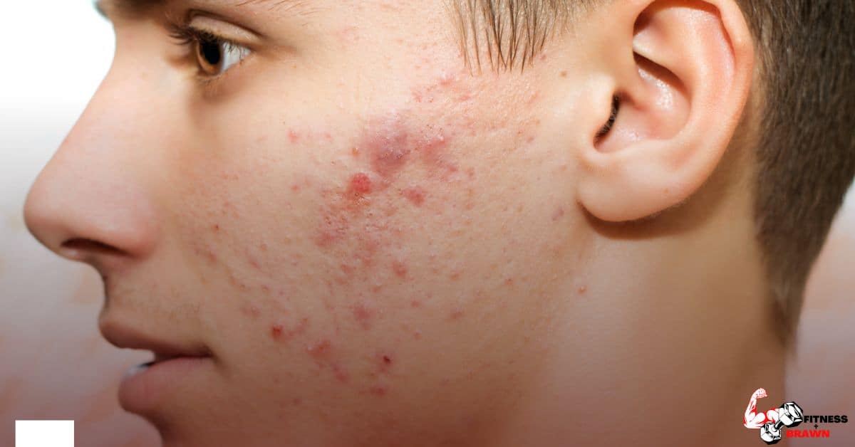 acne - 14 Deca Durabolin Side Effects:Why Should You Avoid It?
